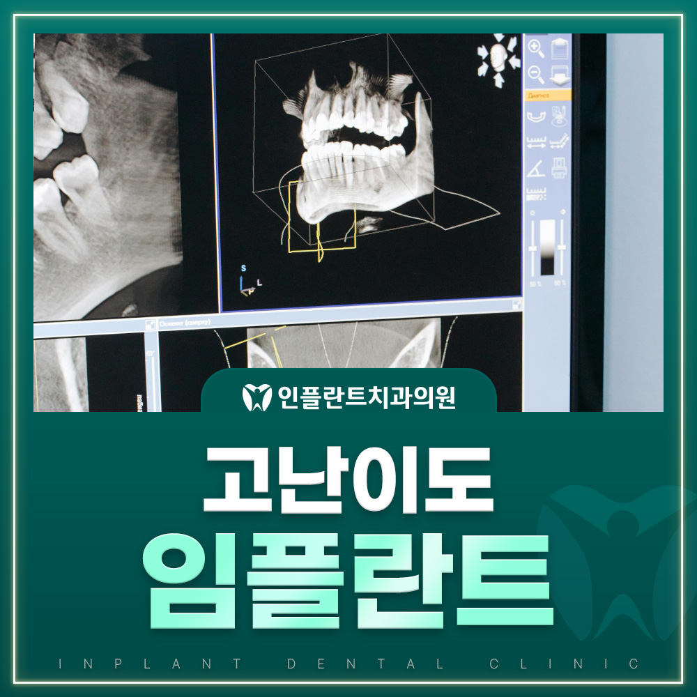 고난이도 임플란트